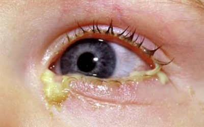 WHO Alert about eye injury due to errors in administration of Chlorhexidine!
