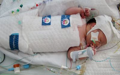 A brief History of Neonatal Hypothermia